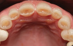 Fig 4. Close-up occlusal view of maxillary anterior teeth showed moderate erosion.