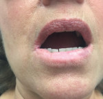 Fig 2. Improved appearance of lower lip after 1 year of treatment.