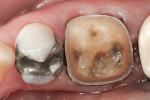 Figure 2  Preparation for a zirconia crown on tooth No. 30.