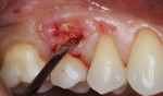 Fig 3 and Fig 4. Gingival margin elevation performed with a microsurgical periosteal elevator.