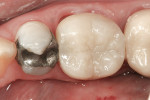 Figure 3  A Lava zirconia crown on tooth No. 30.