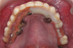 Fig 2. Occlusal view of fractured hybrid prosthesis.
