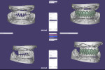 Fig 7. CAD files of individual single crowns on the titanium frameworks.