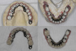 Fig 9. Titanium frameworks covered with opaque and veneered at the cervical area with gingiva-colored composite resin.