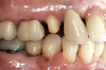 Figure 6  Preparation for a Lava zirconia crown on tooth No. 4.