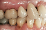 Figure 8  Zirconia crown on tooth No. 4.