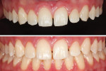 Fig 3. Intraoral photographic protocol. Upper: full maxilla arch with black contrast to elucidate teeth features; lower: maximum intercuspation relationship.