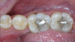 Figure 1  A preoperative view was taken of the patient’s old amalgam restorations, before being replaced with Tetric EvoCeram.