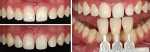 Fig 7. Comparison of teeth before (upper left) and after (lower left) dental reductions. Sharp edges were rounded, and enamel was grinded to make it flat. Most of the teeth faces already have enough space for ceramic restoration and need just a small amount of insertion path correction. Tooth shade selection is shown on the right.
