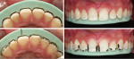 Fig 6. Silicone guide positioned to show the volume of the final restoration compared to the tooth surface, on buccal (upper left) and incisal (upper right) aspects. This guide allows visualization of tooth areas that need to be reduced, as demarcated in black (lower left and lower right), and adequate space for restorations even before tooth preparation.