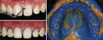 Fig 8. Placement of double gingival retraction cords (upper and lower left) to obtain a mold (right) using simultaneous impression technique.