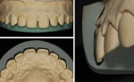 Fig 9. Verification of space between final cast and preparation silicone guides. Upper left: enough space was available to build ceramic restorations on incisal face; lower left: visualization of space on buccal face; right: incisal and buccal space to build the ceramic restoration.