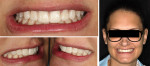 Fig 5. The copy of the diagnostic wax-up was transferred to the patient’s mouth, allowing a preview of the restorative result (mock-up). Upper left: frontal view; lower left: lateral views of the patient’s smile showing the new configuration of tooth alignment and shape; right: relationship between the new teeth configuration and patient’s face.