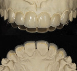 Fig 10. Finalized ceramic restoration placed on cast, buccal (upper) and palatine (lower) views.