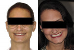 Fig 13. Before restorative treatment (left), the patient demonstrated a moderate, shy smile; after treatment (right), the patient appeared to be very satisfied and more self-confident.