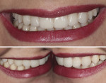 Fig 12. Immediate results after ceramic veneer cementation, frontal (top) and lateral (bottom) views. The esthetic result was achieved by following all diagnostic, planning, and execution procedures.