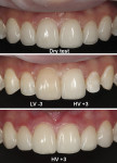 Fig 11. Dry test of ceramic veneer and analysis of marginal fit (top); try-in step cementation in central incisors, using the lowest value (LV -3) and the highest value (HV +3) try-in pastes to evaluate the influence of cement shade on the final color of restoration (center). After trying several cement shades, the highest-value cement was selected (high value, +3 Variolink Veneer) (bottom).