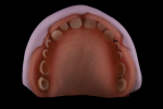 Fig 9. Denture teeth are reduced from the basal surface using a 3D-printed reduction jig.