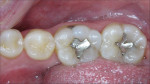Figure 11  The before-and-after postoperative views of teeth Nos. 30 and 31.