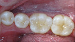 Figure 12  The before-and-after postoperative views of teeth Nos. 30 and 31.