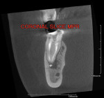Figure 2  A coronal MPR showed a short fill on the mesial–lingual and a radiolucency.