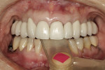 Figure 2  A leaf gauge was used to produce bilateral, simultaneous occlusal contact in centric relation.