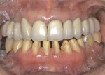 Figure 3  The prepared mandibular left first bicuspid and anterior teeth. The posterior teeth maintained vertical dimension and centric relation contact.
