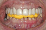 Figure 4  Interocclusal registration of prepared teeth. The posterior teeth determined the correct inter-arch position