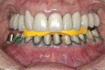 Figure 5  The prepared mandibular posterior teeth. The anterior interocclusal record will maintain the proper inter-arch positioning. Patients should be advised to bite “half-hard” into the registration to prevent posterior over-closure.
