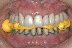 Figure 6  Registration material was added to the posterior quadrants. Practitioners must take care not to inject more material onto the occlusal surface of the existing registration.