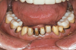 Figure 9  The remaining teeth were prepared with molars provisionalized as occlusal stops.