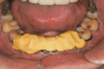 Figure 10  The patient registered the proper vertical and occlusal relationship on the anterior preparations. The interocclusal record was re-inserted after the molar provisional was removed.