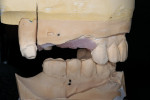 Figure 12  Casts for a fixed implant restoration. The interocclusal registration was fabricated by injecting bite registration material over the soft tissue and the patient was instructed to close in centric relation.