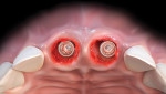 Fig 1. Implants are placed to the palatal aspect of extraction sockets.