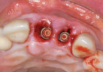 Fig 7. Immediate implants placed in the palatal aspect of both extraction sockets.