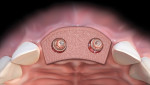 Fig 4. Dermal allograft is trimmed to match subperiosteal zone and perforated according to position of abutments.