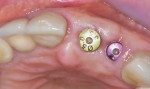 Fig 9. At 2 months healing, preserved ridge
dimensions and healthy peri-implant mucosa were demonstrated.