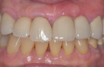 Fig 10. Final cement-retained crowns on both implants (restorative therapy performed by Ralph C. Attanasi, DDS, MS, and Ethan A. Pansick, DDS, MS).