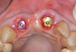 Fig 12. Particulate bone graft material was placed to obturate the gap between the implants and socket walls. The graft was placed to a vertical level slightly coronal to the facial crest.