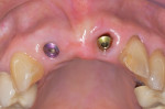 Fig 16. At 9 weeks post-surgery, the abutment on the No. 9 implant was changed in favor of a taller but narrower abutment to facilitate coronal migration of the soft-tissue margin and easier access for provisionalization.