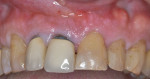 Fig 18. Pretreatment condition of teeth Nos. 7 and 8 with mobile crowns and recurrent caries.