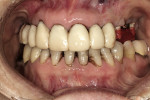 Figure 16  The provisional restorations were adjusted to centric relation and the interocclusal jig will now maintain that relationship when a bite registration against the preparations was fabricated.