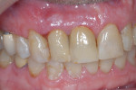 Fig 20. Final single-unit, cement-retained crowns Nos. 7 and 8 (restorative therapy performed by Brian L. Wilk, DMD).