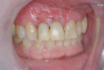 Fig 19. Screw-retained, immediate temporization of implants Nos. 7 and 8. These crowns were splinted and out of occlusal contact.