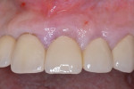 Fig 6. Clinical situation with mobile crowns on teeth Nos. 9 and 10.