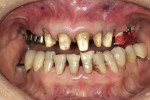 Figure 18  The patient’s maxillary posterior right quadrant was prepared for healing head implant interocclusal registration. The heads must significantly clear the tissue collar.