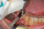 Fig 10. Implant placement utilizing surgical guide and CEREC guide drill key.