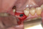 Fig 11. Surgical site after implant placement.
