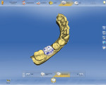 Fig 1. Virtual wax-up of crown tooth No. 30.