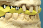 Figure  19  A properly trimmed registration demonstrates the use of healing heads to register the bite.